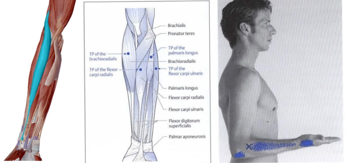 Brachioradialis