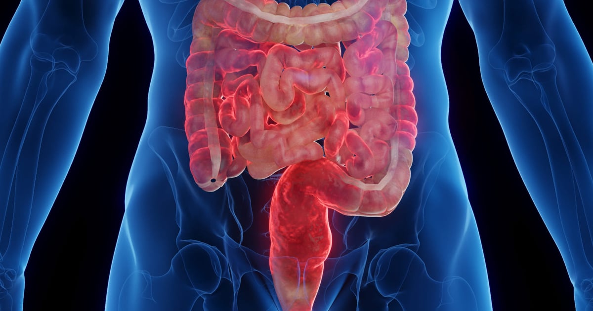 Crohn Hastalığı