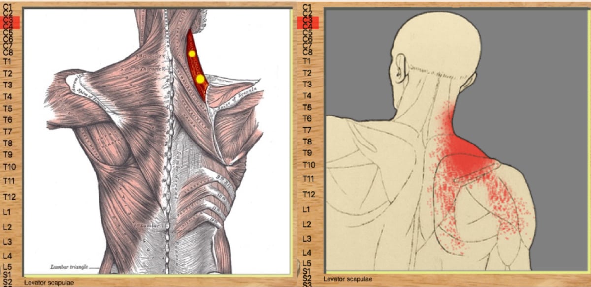 Levator Scapula - Omuz Kol Ağrısı Yapan Kaslar