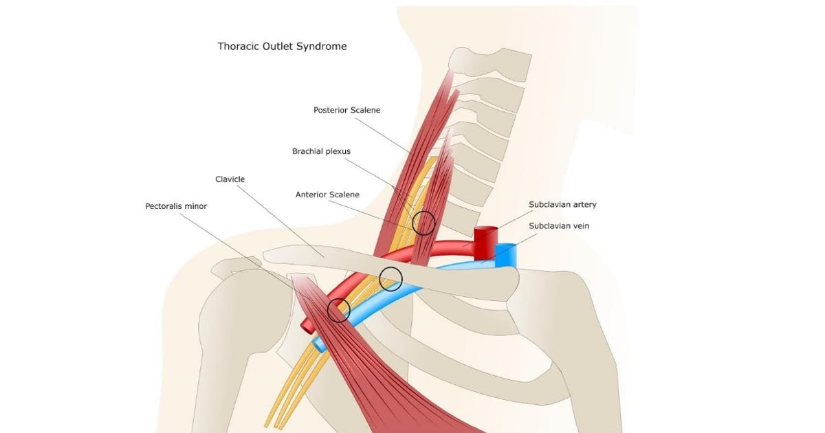 Torasik Outlet Sendromu